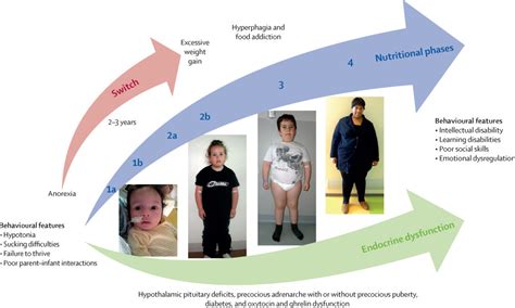 prader willi syndrome endocrine problems